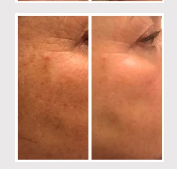 pigment verstoring en fijne lijntjes