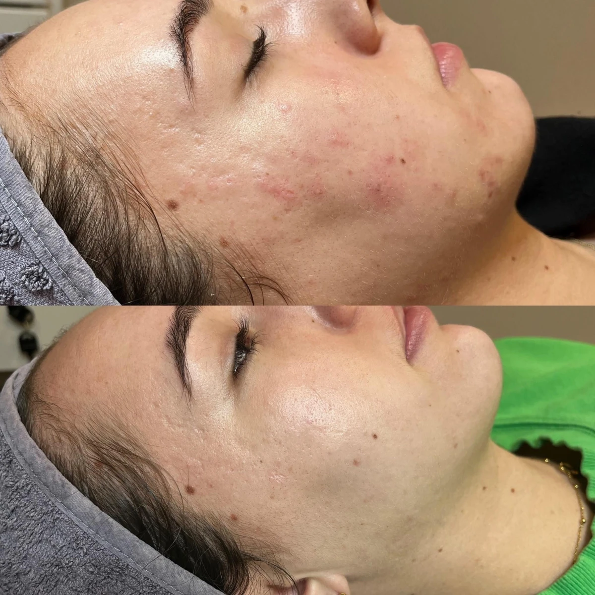 Glycopeel Behandeling – Voor een Stralende, Gladde en Jeugdige Huid in plannen ? 