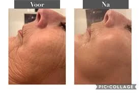 Optima(Q10 Anti-rimpel en vroegtijdige veroudering) start set Keenwell