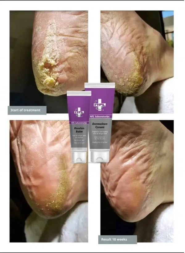 Dermoleen Cream optimale hydratatie van de droge huid - Foto 2