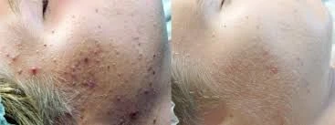 Balancing Purifying Start stet  voor de onzuivere en vette huid  BALANCERENDE ZUIVERENDE OLIEVRIJ   - Foto 9