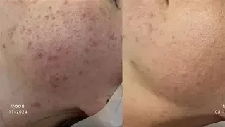 Balancing Purifying Start stet  voor de onzuivere en vette huid  BALANCERENDE ZUIVERENDE OLIEVRIJ   - Foto 11