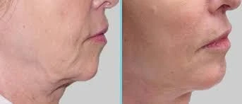Superlifting Anti-wrinkle Day Cream - Foto 6