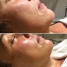 extra verstevigend en anti-veroudering) Keenwell Tensilift of Densilift - Foto 7