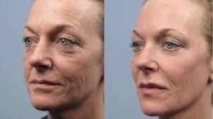 Optima(Q10 Anti-rimpel en vroegtijdige veroudering) start set Keenwell - Foto 2