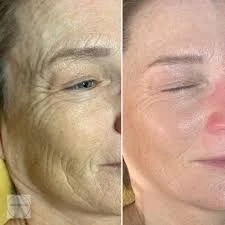 De luxe TENSILIFT-set is een zeer effectief anti-verouderings product voor de huid  - Foto 2