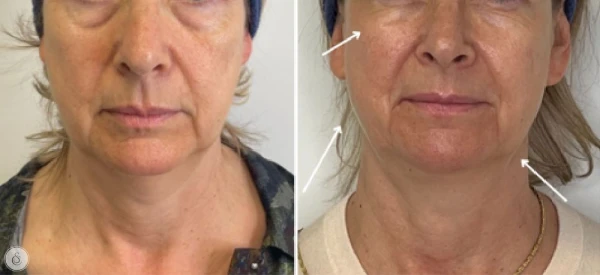 Anti-wrinkle Lifting  Eye Contour Cream - Foto 3